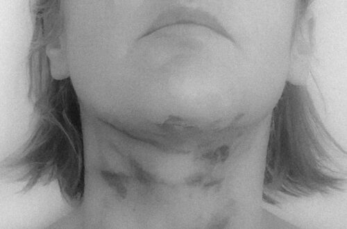 Hals met blauwe plekken na lioposuctie