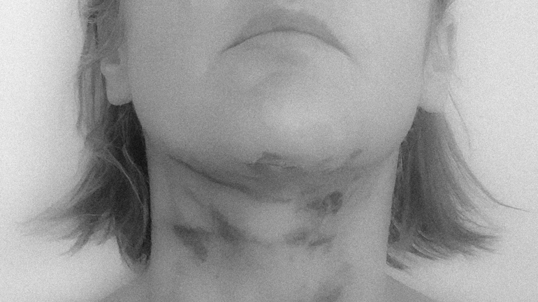 Hals met blauwe plekken na lioposuctie